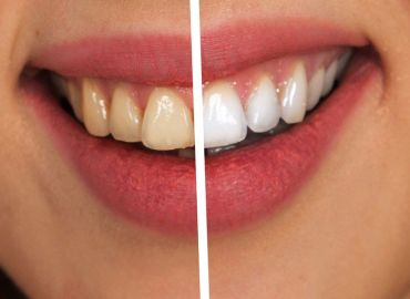 Tecnología sin dolor: descubre la limpieza dental con AirFlow y Perioflow
