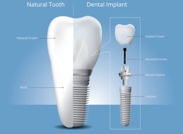 De qué material están hechos los implantes